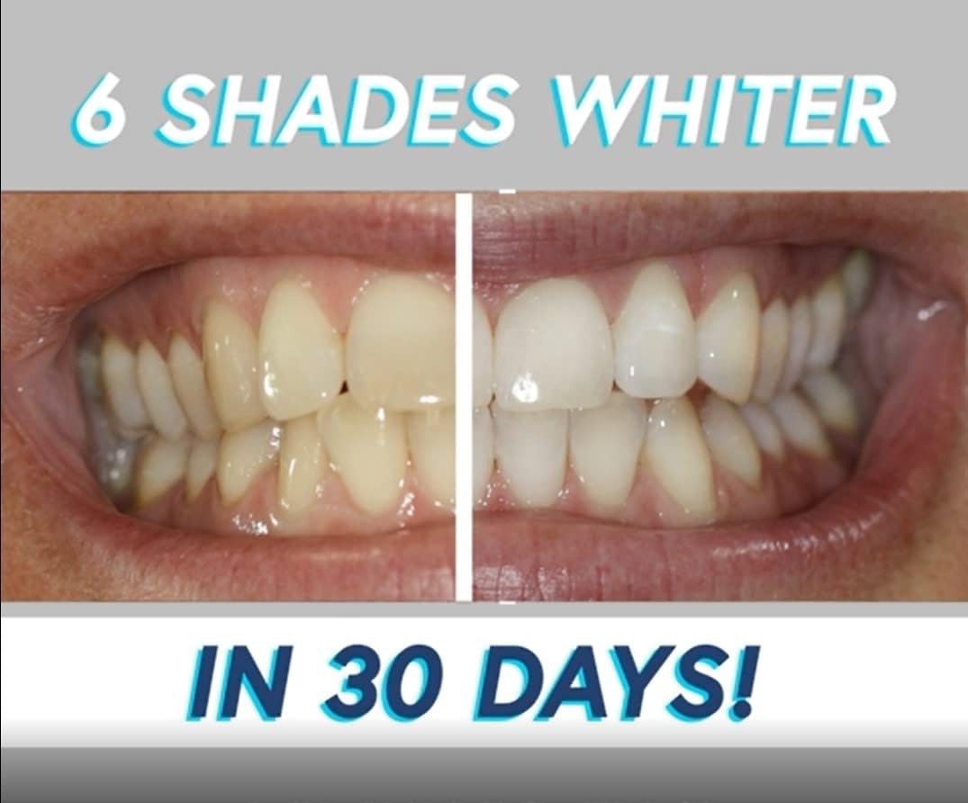 Smileactives Bolígrafo blanqueador de dientes para sonrisa blanca,...