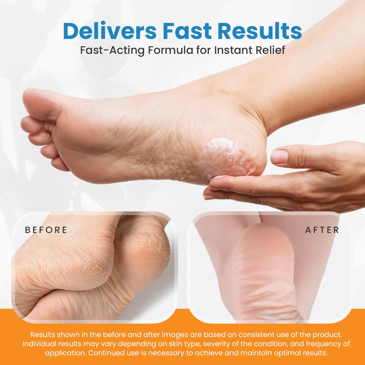 Revitaderm 4D 40% Urea Advanced Crema para pies para talones agriet...