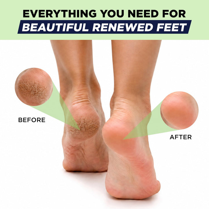 Removedor de callos para pies con gel extra fuerte y juego de piedr...