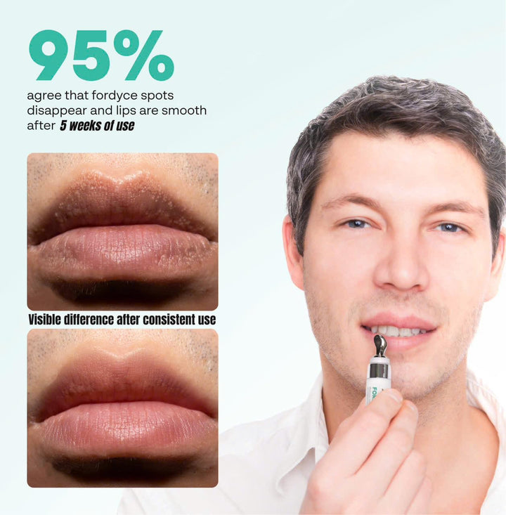 Crema Abera Fordyce \u2013 Fórmula avanzada con HPR (retinoides de...