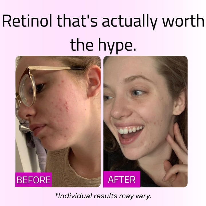 GLEOW Suero de Retinol para el Rostro con Ácido Hialurónico, el Ret...