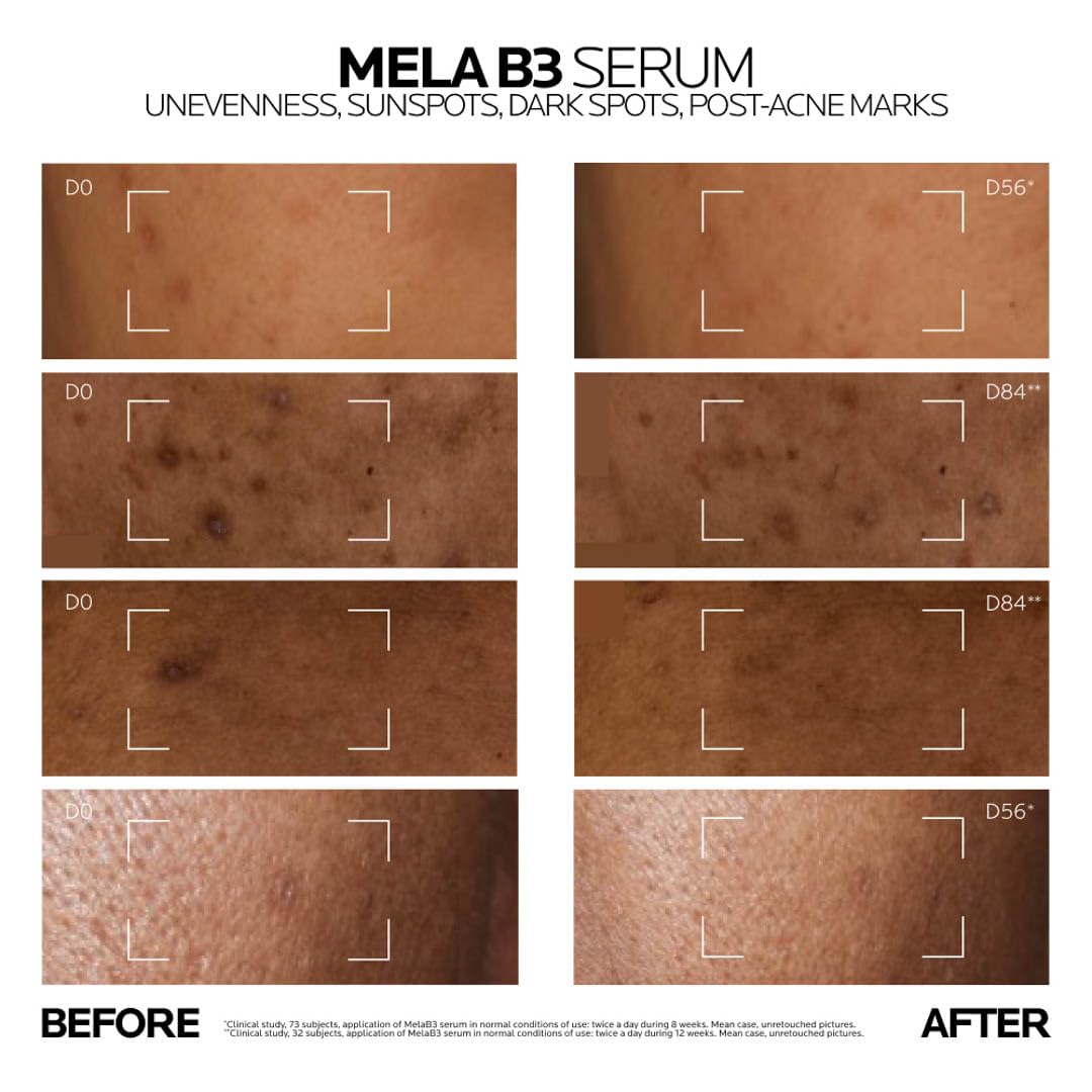 La Roche-Posay Mela B3 Serum, Dark Spot Corrector With Anti-Aging M...