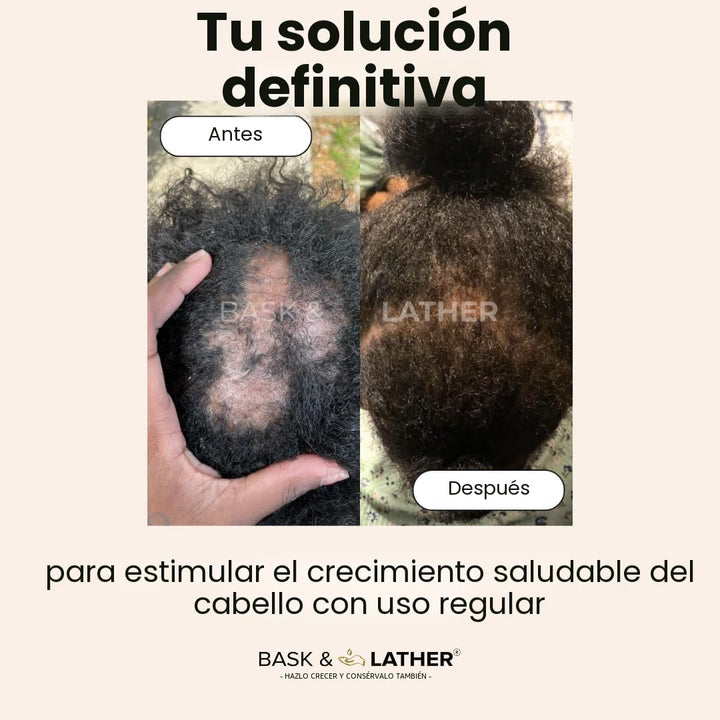 Aceite para el crecimiento del cabello y estimulador del cuero cabe...