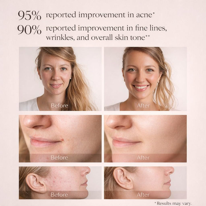 Aphrona Máscara facial con luces LED Halo, terapia de luz LED para...