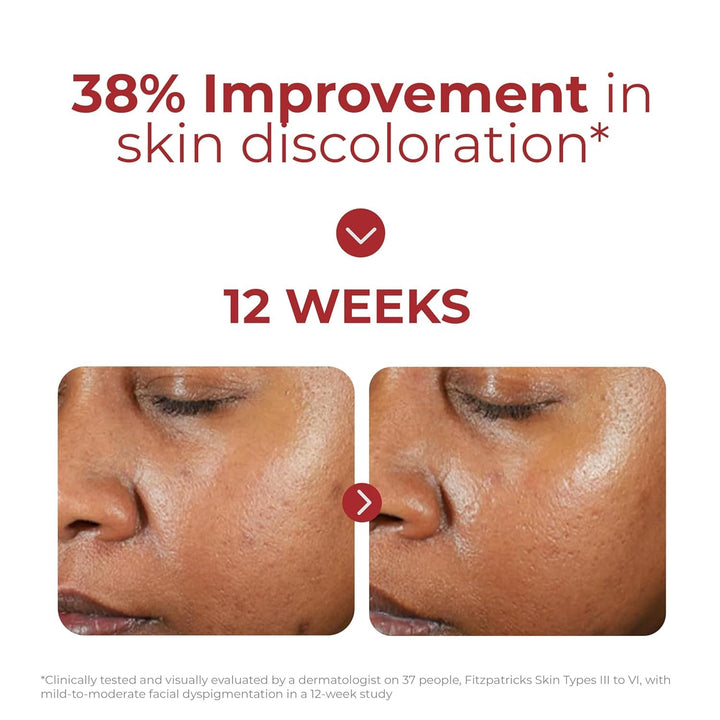 EltaMD UV Clear Face Sunscreen SPF 46, Oil-Free Sunscreen with Zinc...