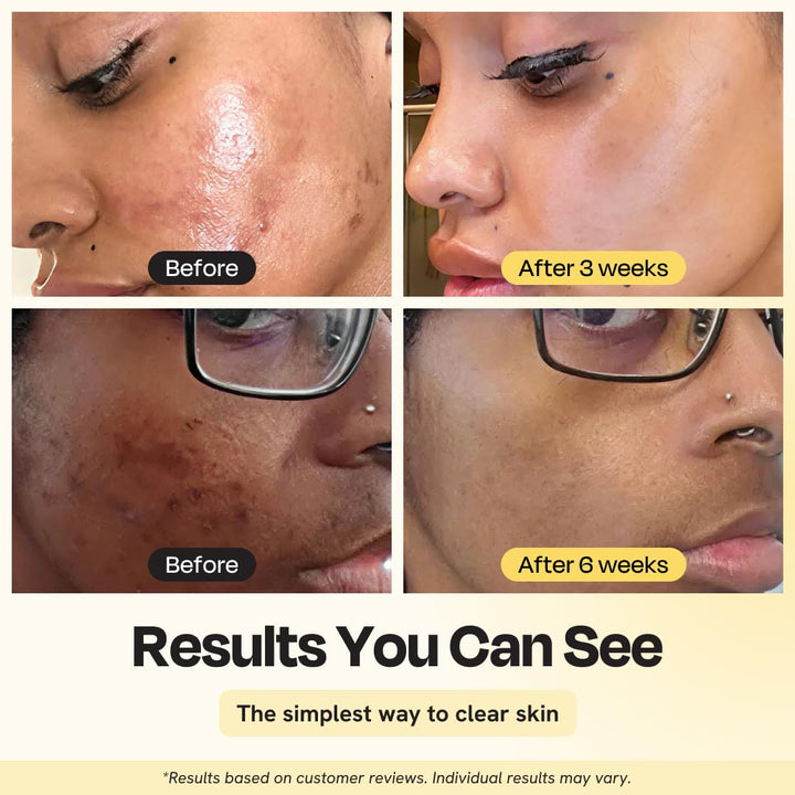 Gleamin Mascarilla de arcilla con vitamina C para manchas oscuras,...