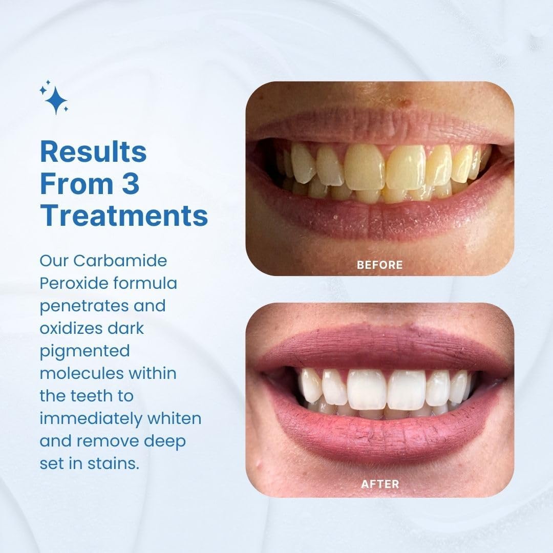 PurelyWHITE DELUXE Kit de blanqueamiento dental, blanqueamiento den...