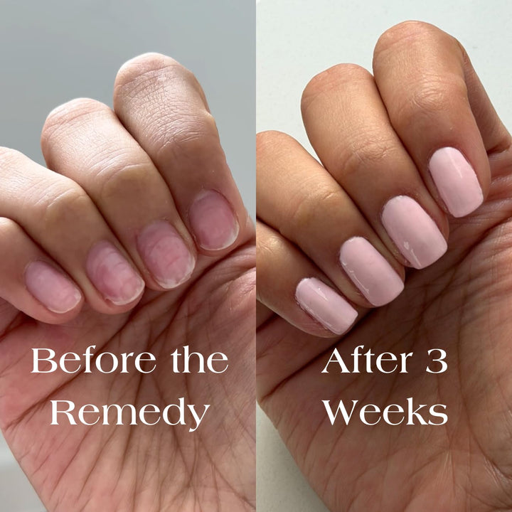 Botanist The Remedy | Esmalte fortalecedor para uñas | Repara y end...