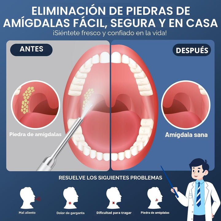 Removedor de cálculos amigdalinos con cámara \u2013 Kit de eliminac...