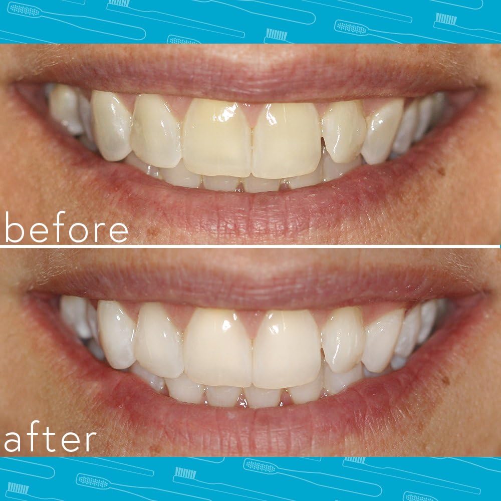 Smileactives Bolígrafo blanqueador de dientes para sonrisa blanca,...