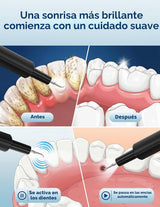 Removedor de placa ultrasónico para dientes, removedor de sarro den...