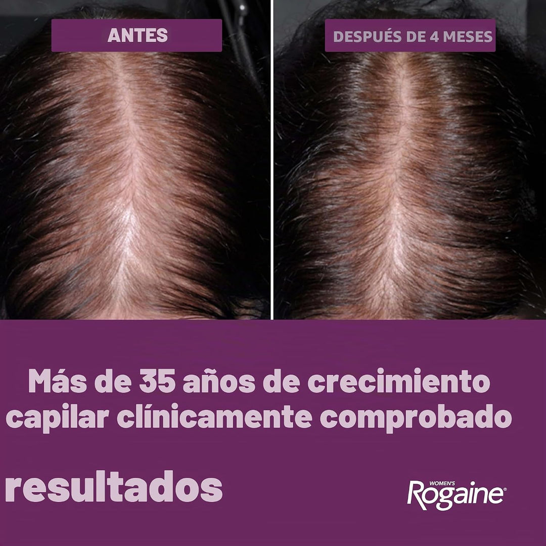 Tratamiento en espuma para pérdida de cabello, de uso diario, sumin...