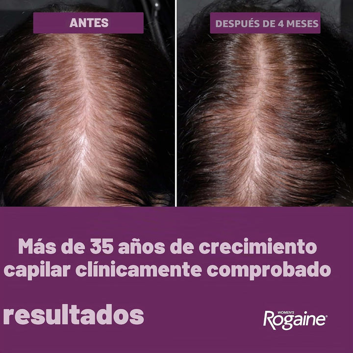 Tratamiento en espuma para pérdida de cabello, de uso diario, sumin...