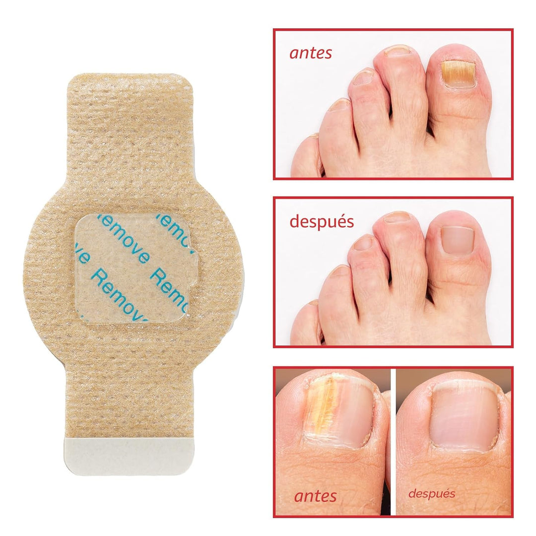 Parches de uñas fúngicas \u2013 Tratamiento de uñas de los pies ext...