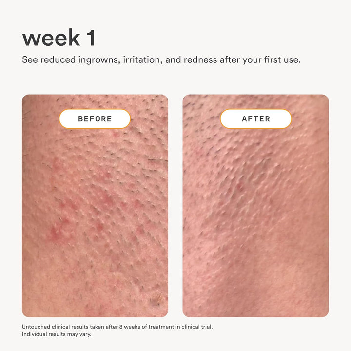 Nood™ Serum | Después del afeitado para evitar el vello encarnado y...