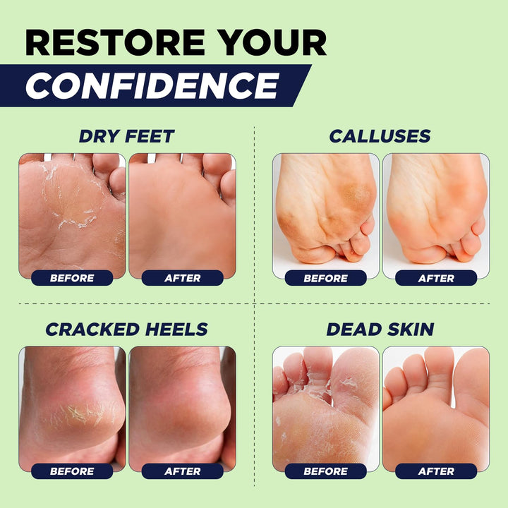 Removedor de callos para pies con gel extra fuerte y juego de piedr...