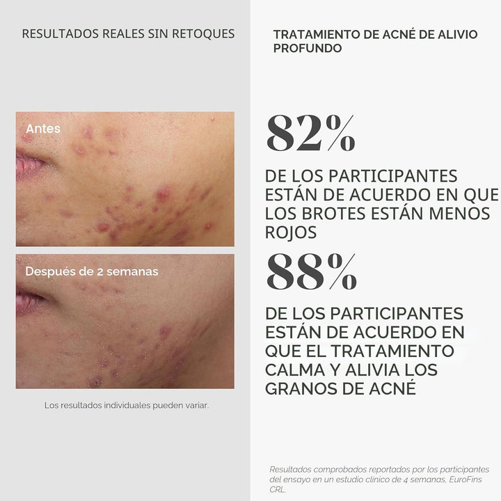 Murad Tratamiento de Acné de Alivio Profundo con Ácido Salicílico a...