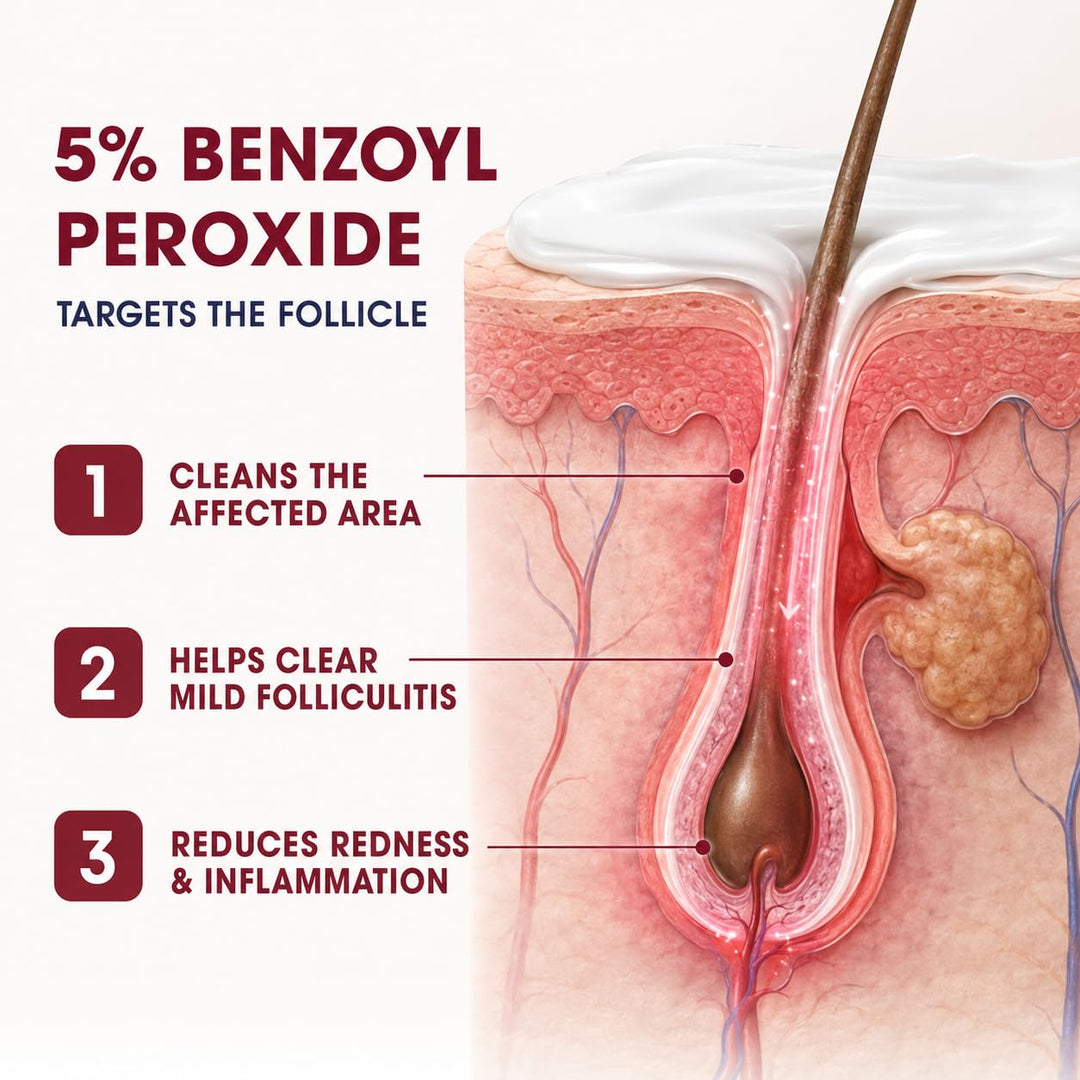 Crema de tratamiento de foliculitis con 5% de peróxido de benzoilo...
