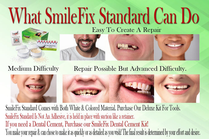 SmileFix Kit de reparación dental estándar - Compuesto de coloració...