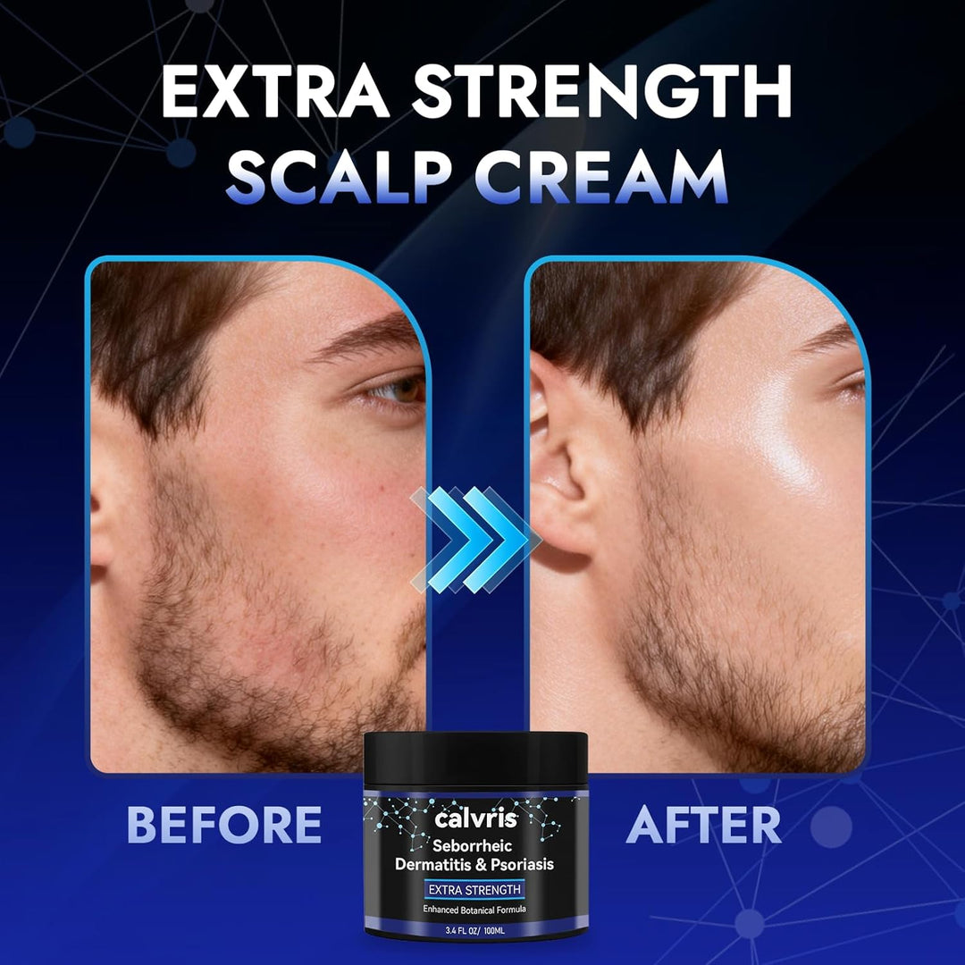 Calvris Crema extra fuerte para el cuero cabelludo, alivio de escam...