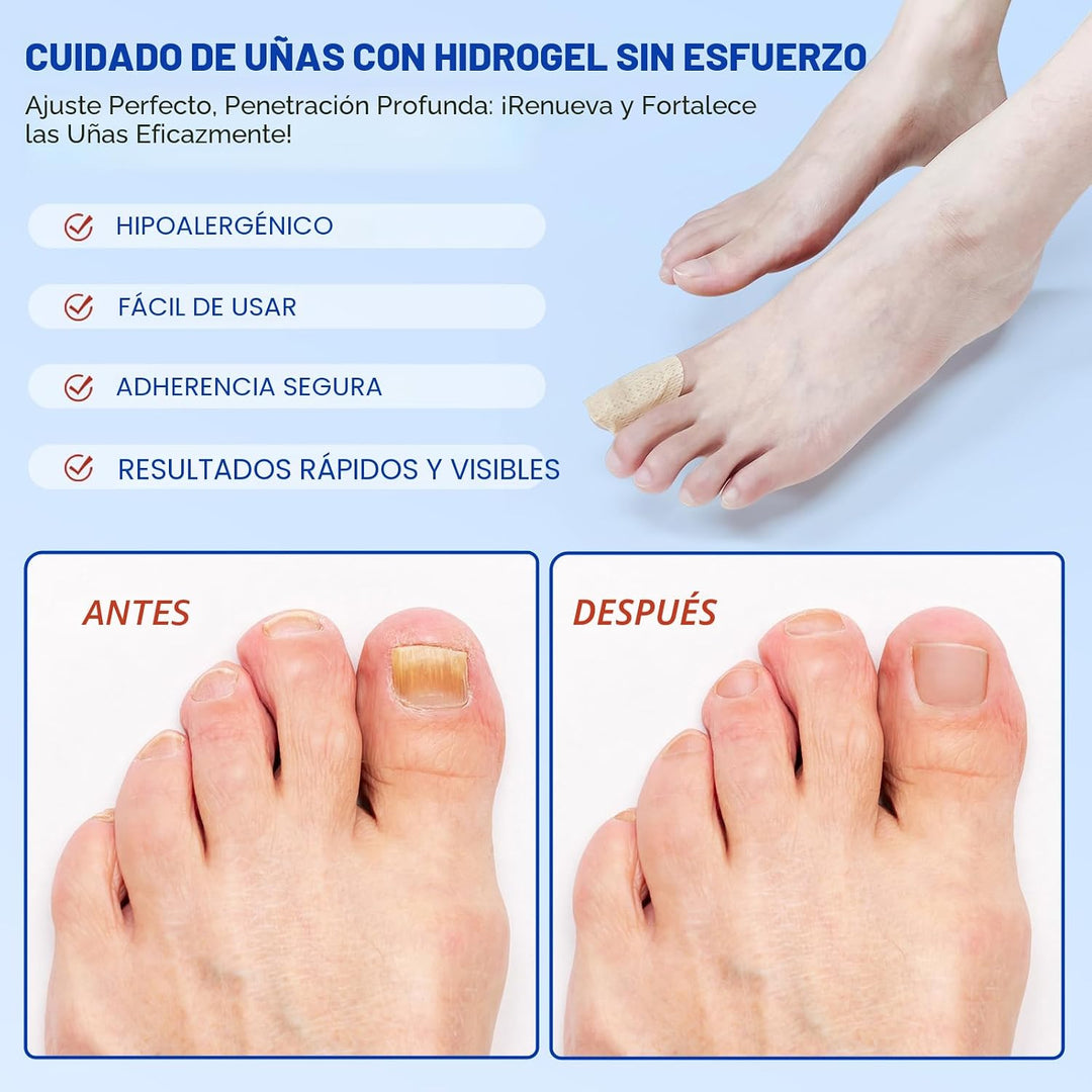 Parches de uñas fúngicas \u2013 Tratamiento de uñas de los pies ext...
