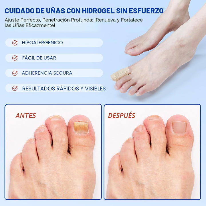 Parches de uñas fúngicas \u2013 Tratamiento de uñas de los pies ext...