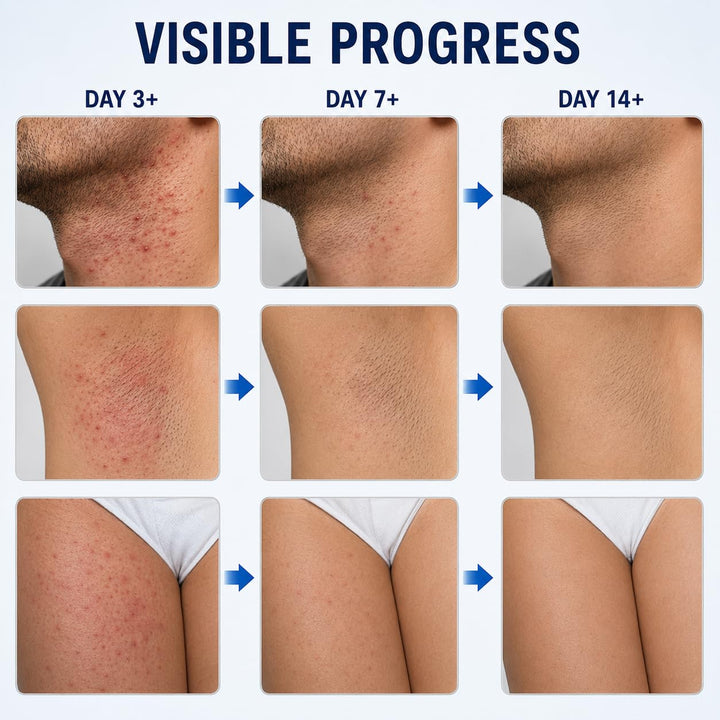 Crema de tratamiento de foliculitis para afeitado y depilación para...