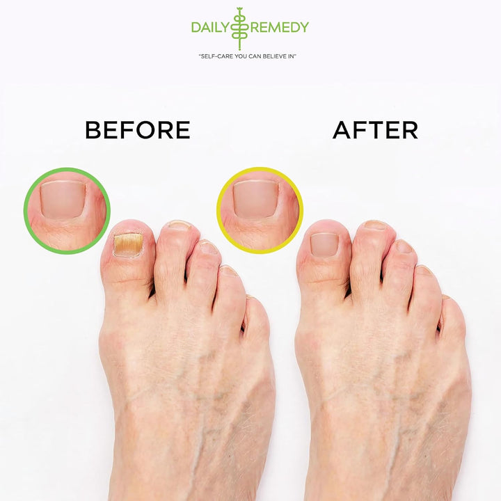 DAILY REMEDY Juego de 4 pies de remojo \u2013 2 aceites de árbol de...