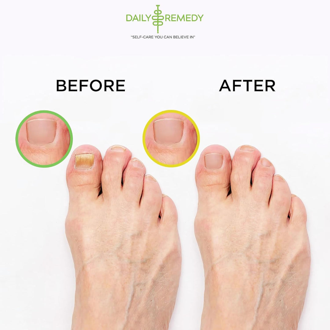 DAILY REMEDY EXTRA STRENGTH - Juego de aceite de árbol de té y cítr...