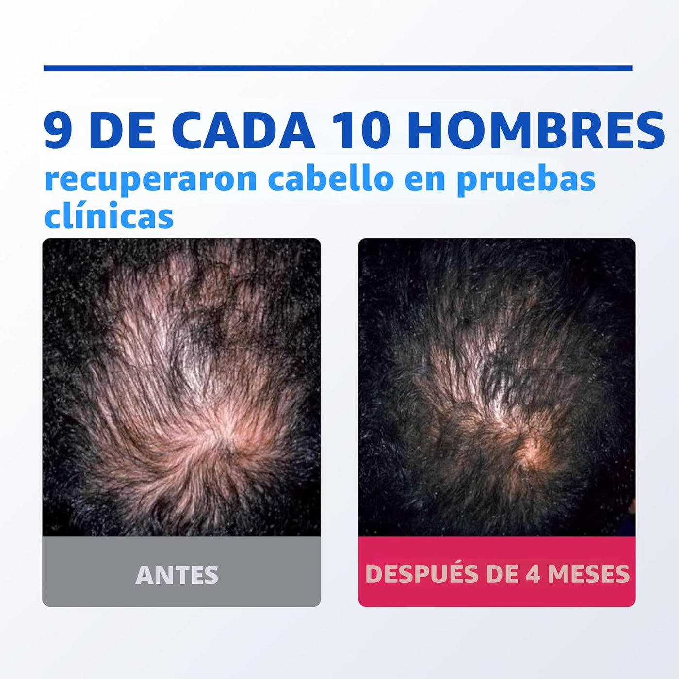 Rogaine para hombres 5% Minoxidil para hombres en espuma, crecimien...