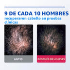 Espuma tópica Rogaine 5% Minoxidil para hombre, sin perfume, 3 x 2.11 oz, 2.11 Ounce (Pack of 3)