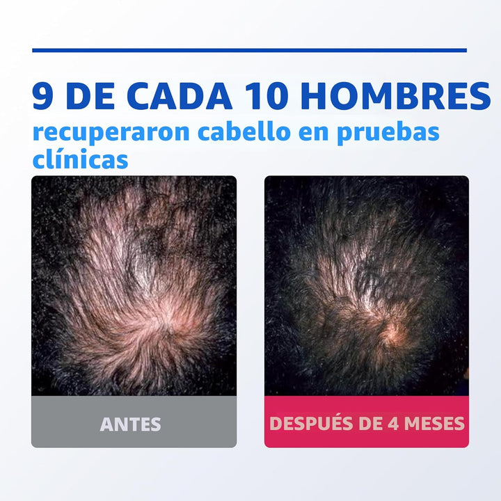Rogaine para hombres 5% Minoxidil para hombres en espuma, crecimien...