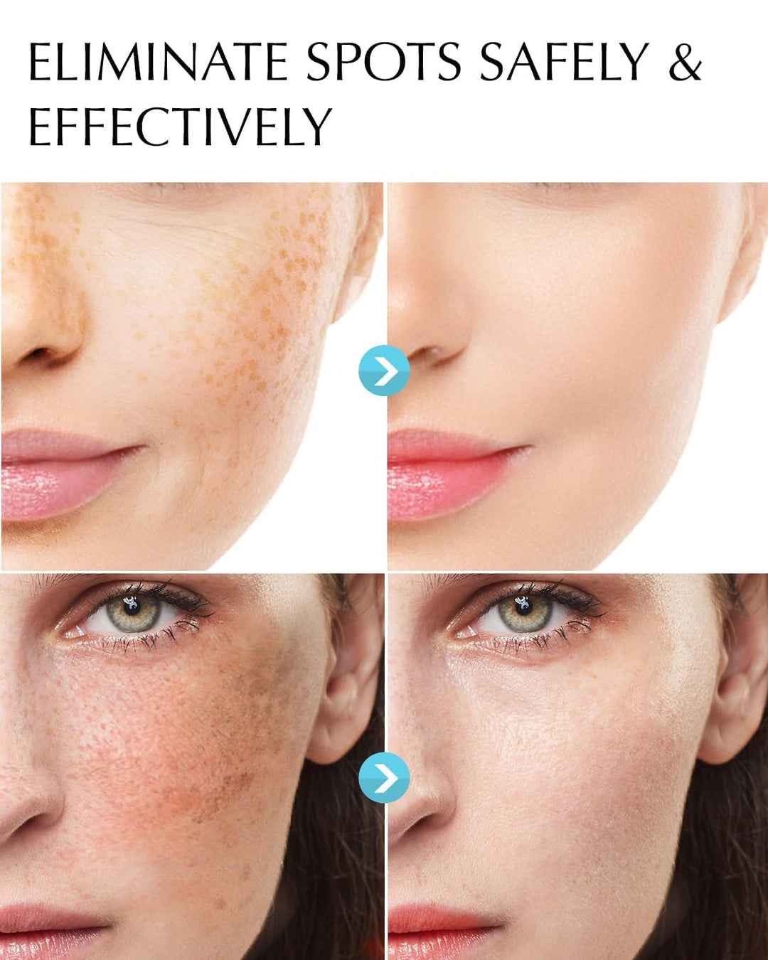Eliminador de manchas oscuras para la cara: suero corrector de manc...