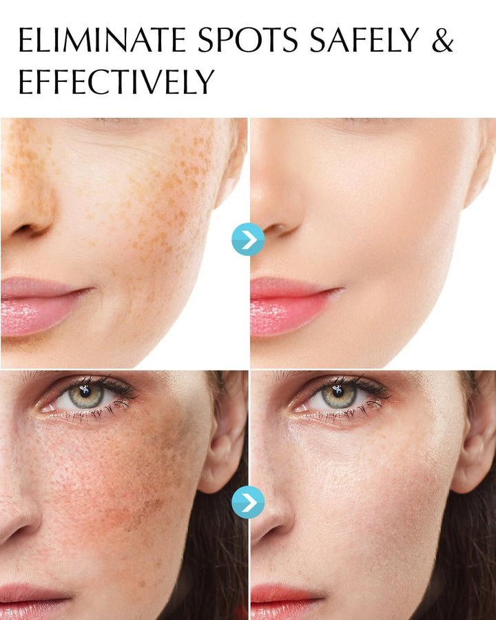 Eliminador de manchas oscuras para la cara: suero corrector de manc...