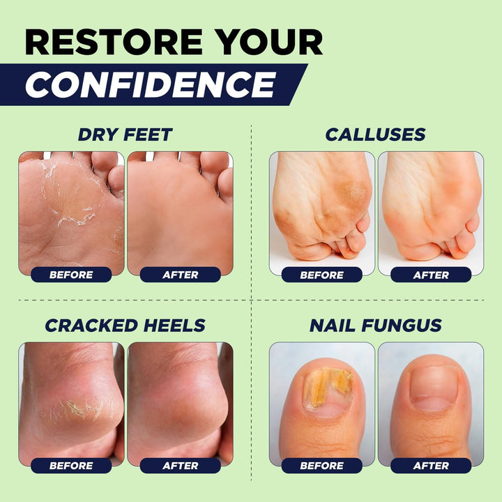 FOOT CURE Aceite de árbol de té para pies con sal de Epsom \u2013 E...