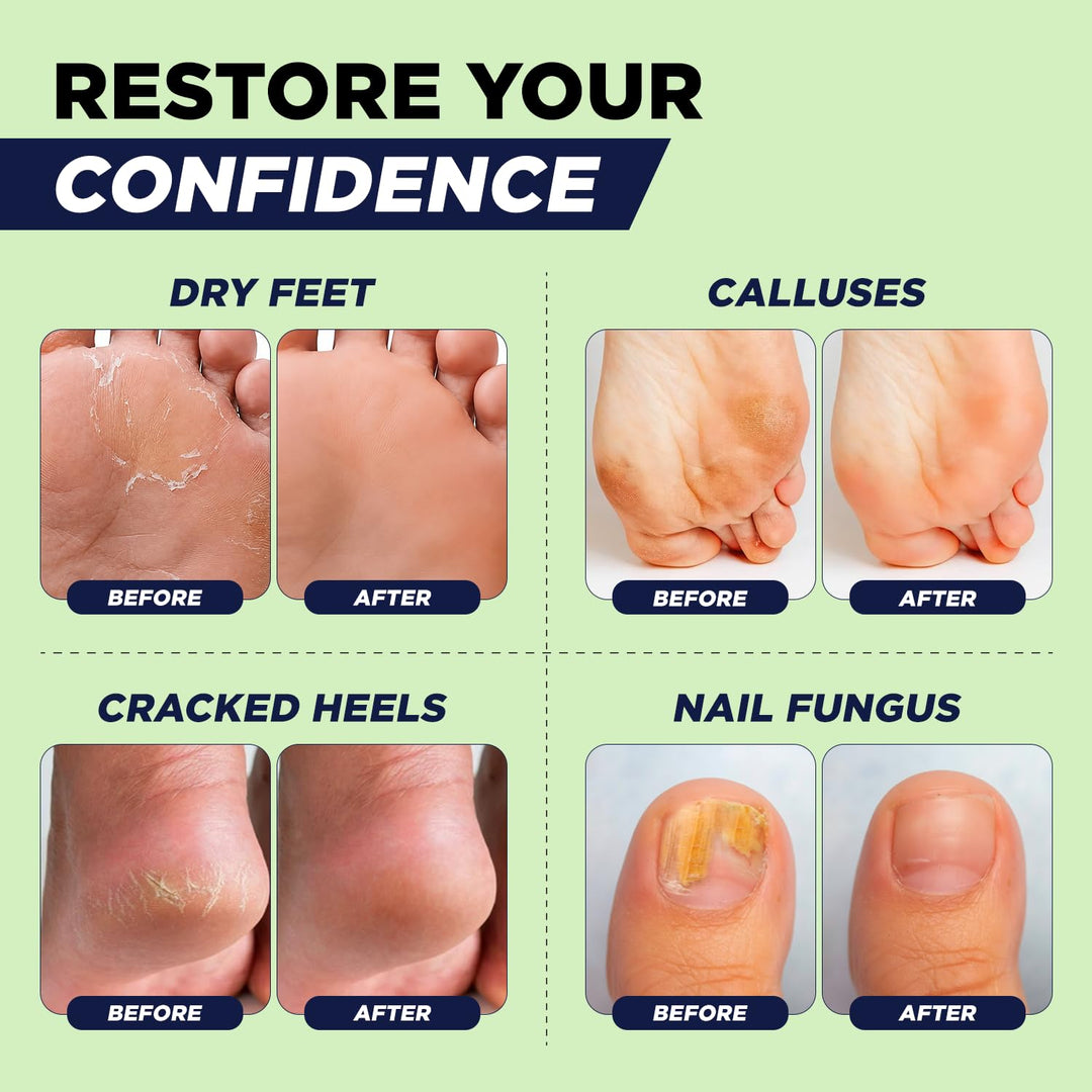 FOOT CURE Juego de pedicura exfoliante y removedor de callos \u2013...