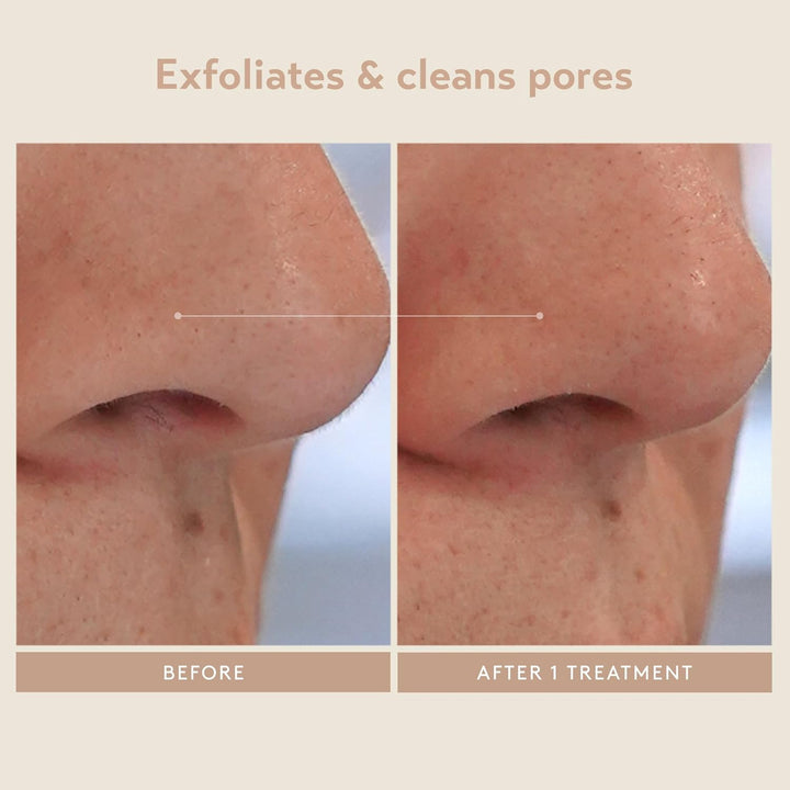 SHANI DARDEN SKIN CARE - Peeling triple ácido, tratamiento exfolian...