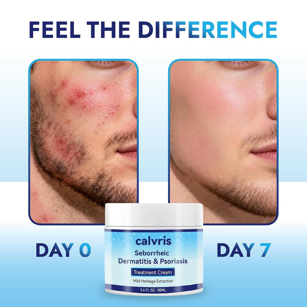 Calvris Scalp Comfort Balm - Fórmula botánica sin esteroides para c...