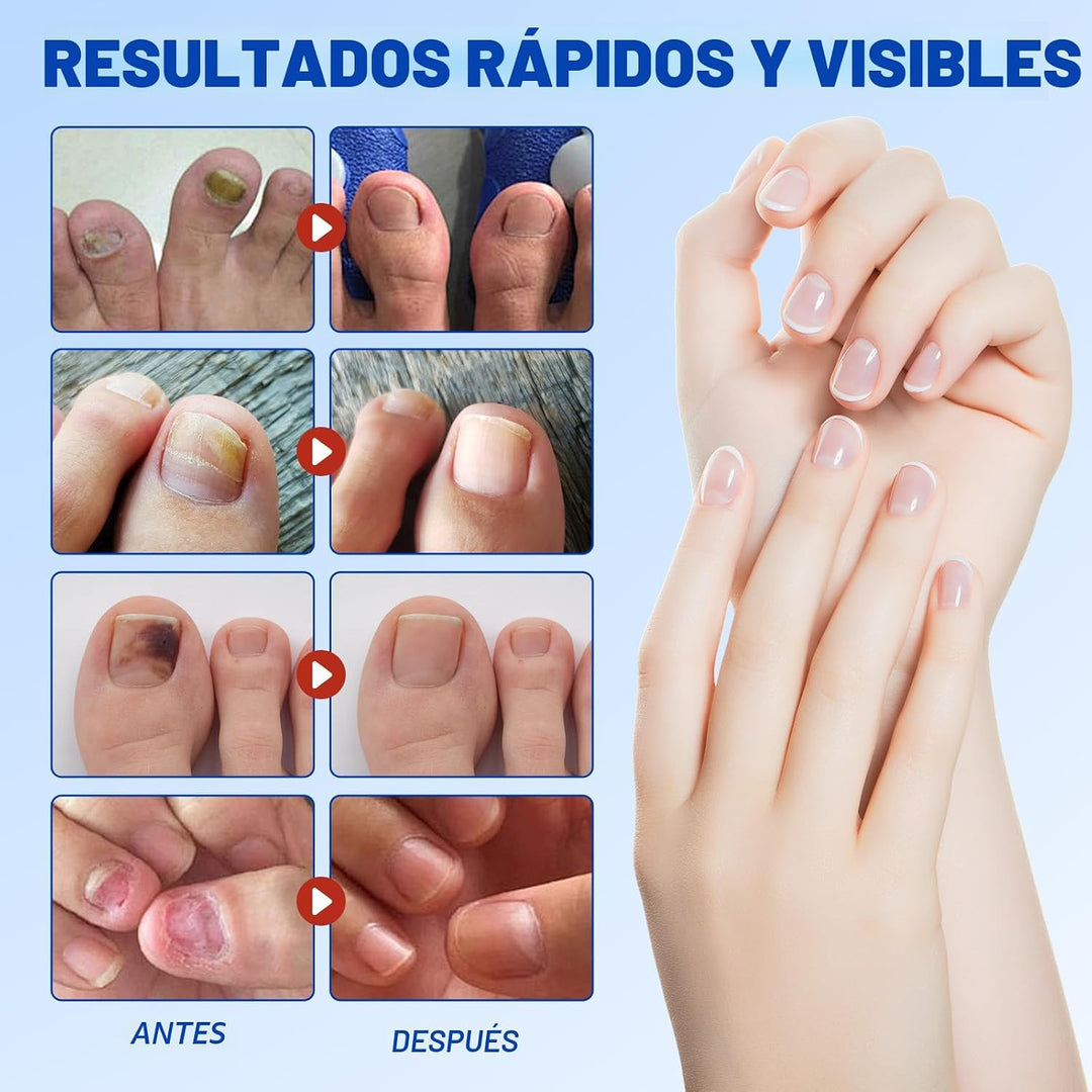 Parches de uñas: 21 parches de reparación extra fuertes para uñas d...