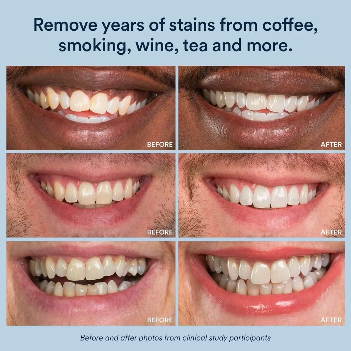 Gel de blanqueamiento de dientes AuraGlow, peróxido de carbamida al...