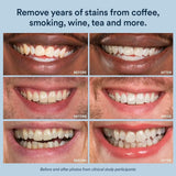 Gel de blanqueamiento de dientes AuraGlow, peróxido de carbamida al...