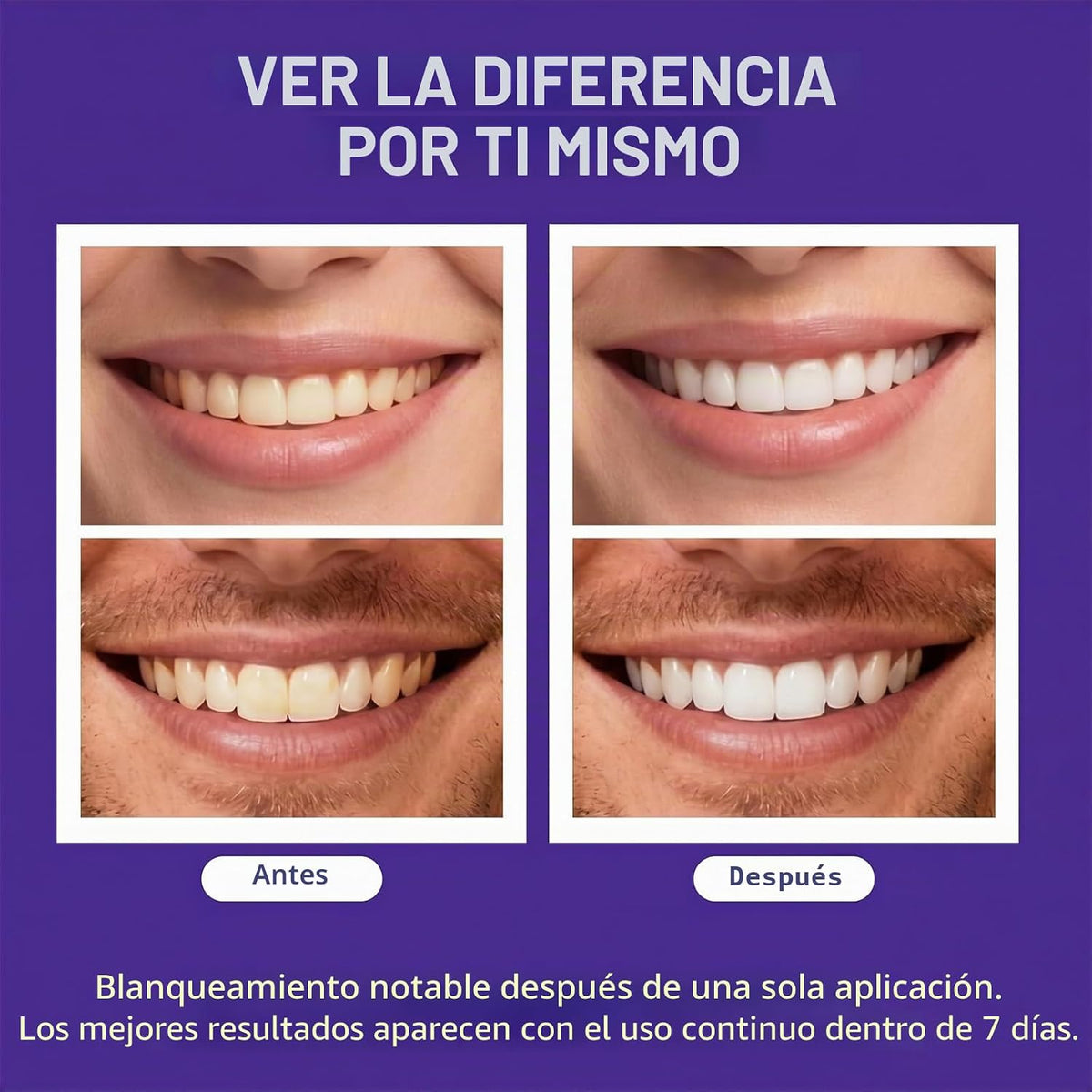 Tiras blanqueadoras de dientes moradas avanzadas, tratamiento de co...