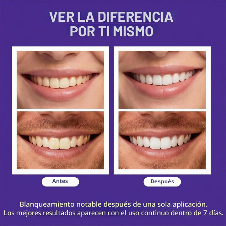 Tiras blanqueadoras de dientes moradas avanzadas, tratamiento de co...