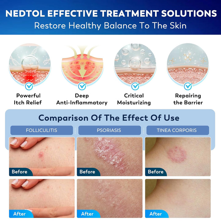 Nedtol Crema para el Tratamiento de la Foliculitis, Ungüento Antiba...