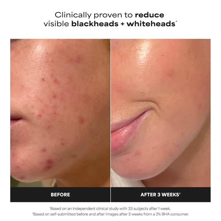 Paula's Choice Skin Perfecting - Exfoliante líquido de ácido sa...