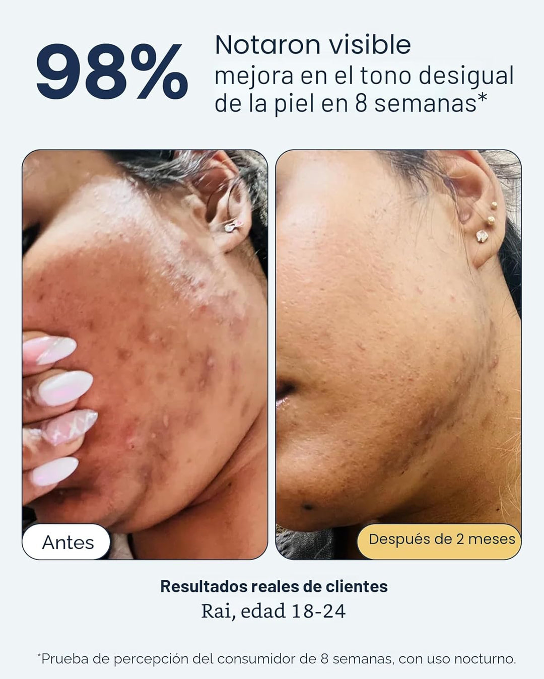 Remedio para las manchas oscuras | Tratamiento nocturno avanzado co...