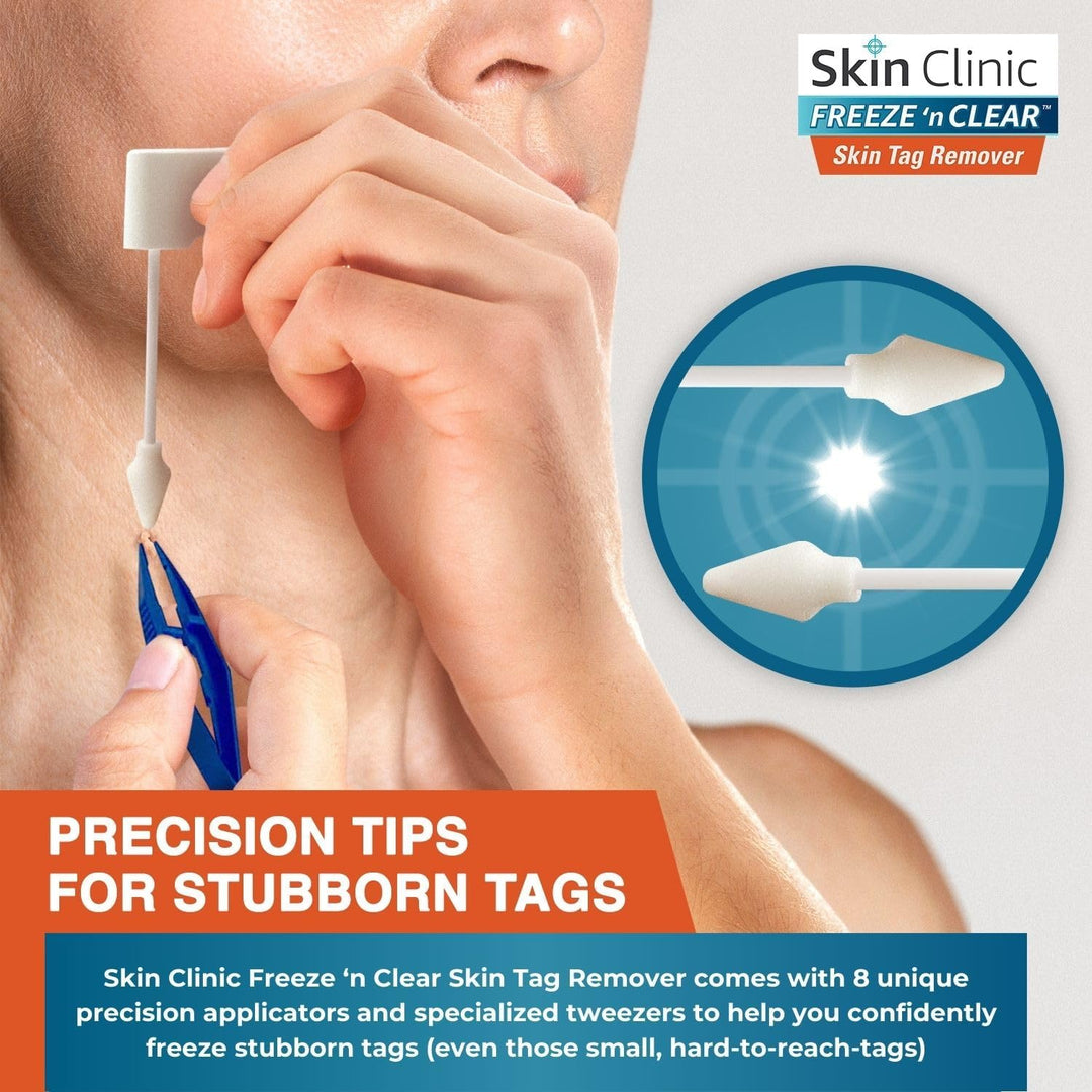 Skin Clinic Freeze n Clear Removedor de marcas cutáneas