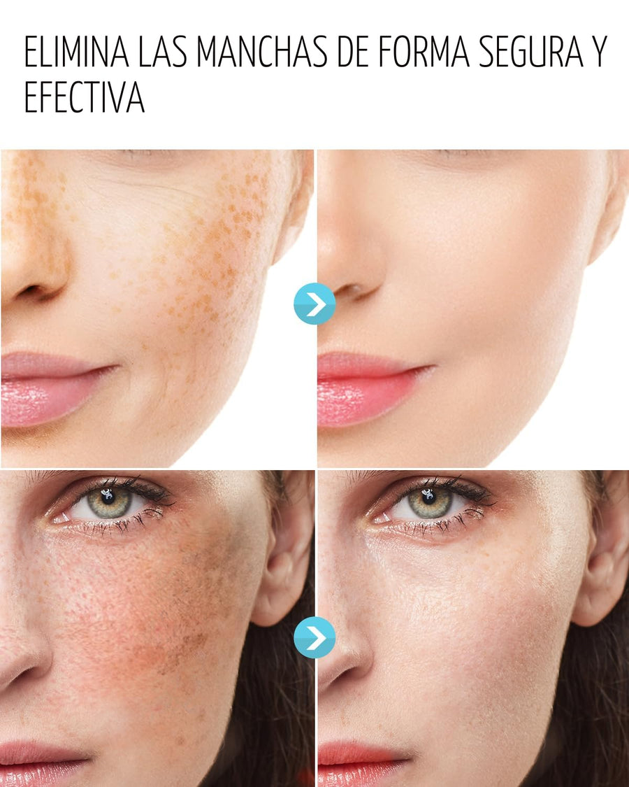 Corrector de Manchas Oscuras para Cara y Cuerpo: Tratamiento de Hip...