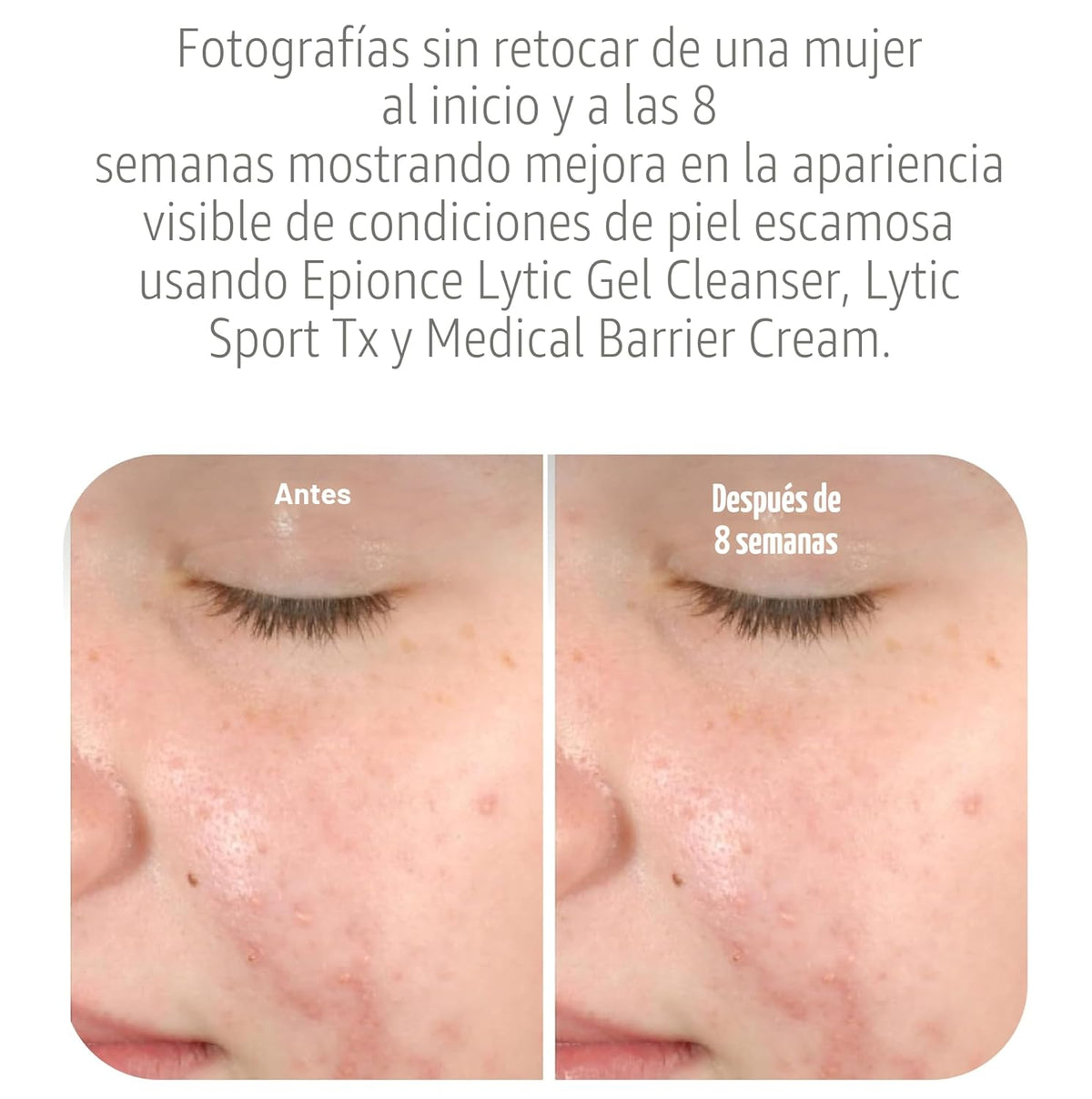Epionce Lytic Gel Cleanser - Limpiador facial y removedor de maquil...