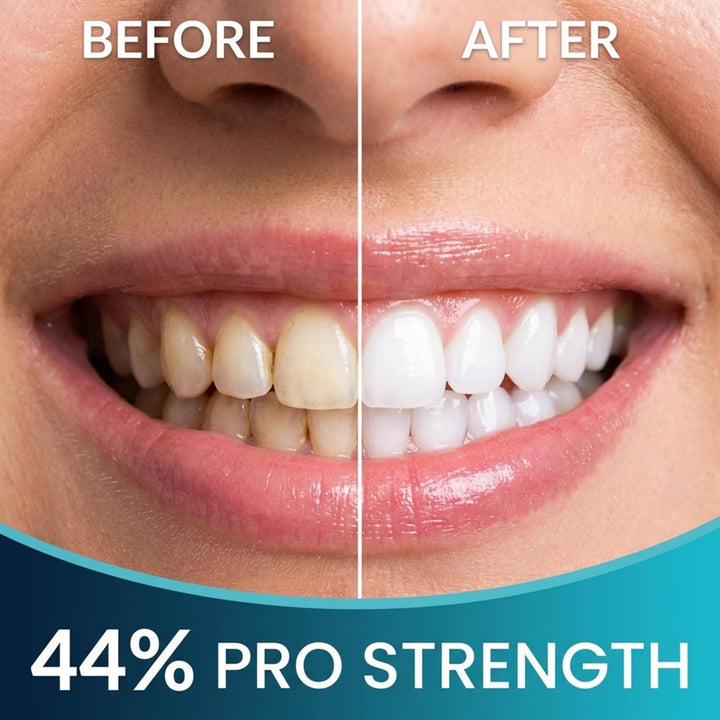Repuestos de gel blanqueador para dientes Cool Teeth Whitening (TM)...